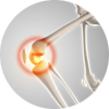 Illustration of knee with arthritis