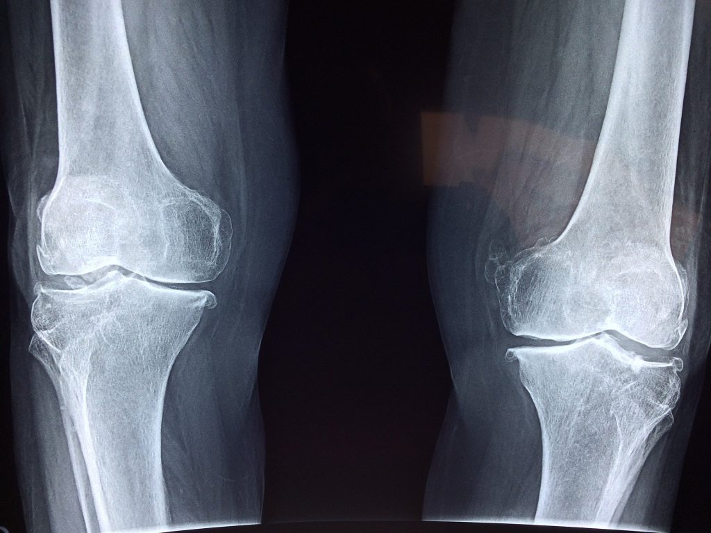 How Physiotherapy Can Help You with Your  Osteoarthritic Knee